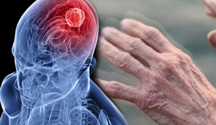 Parkinson Hastalığı İçin Yeni Bir Umut: Kök Hücre Tedavisi